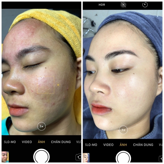 Phục hồi da yếu 