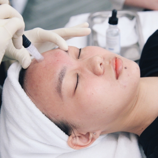 Nặn mụn cơ bản 
