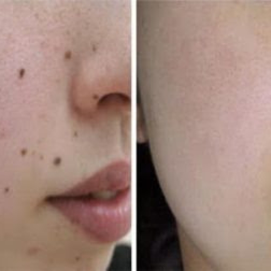 Xử lý đồi mồi, mụn thịt, nốt ruồi